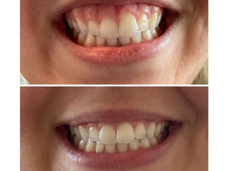 4 Good Reasons to Choose a Dentist for Botox?